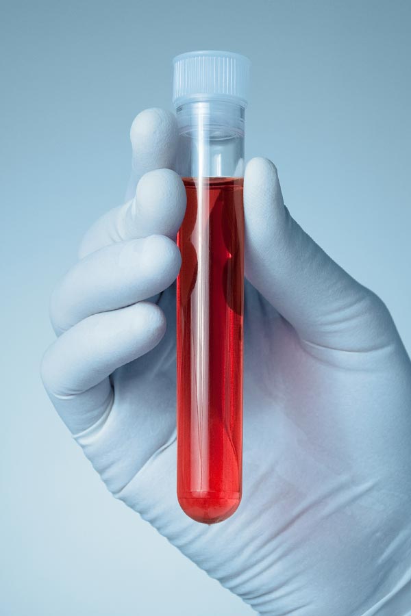 Autoimmune-Treatment Close up of a gloved hand holding a vial of red liquid, representing Guerda Johnson, FNP-C's comprehensive autoimmune disorder treatment in Tyler East Texas Area.