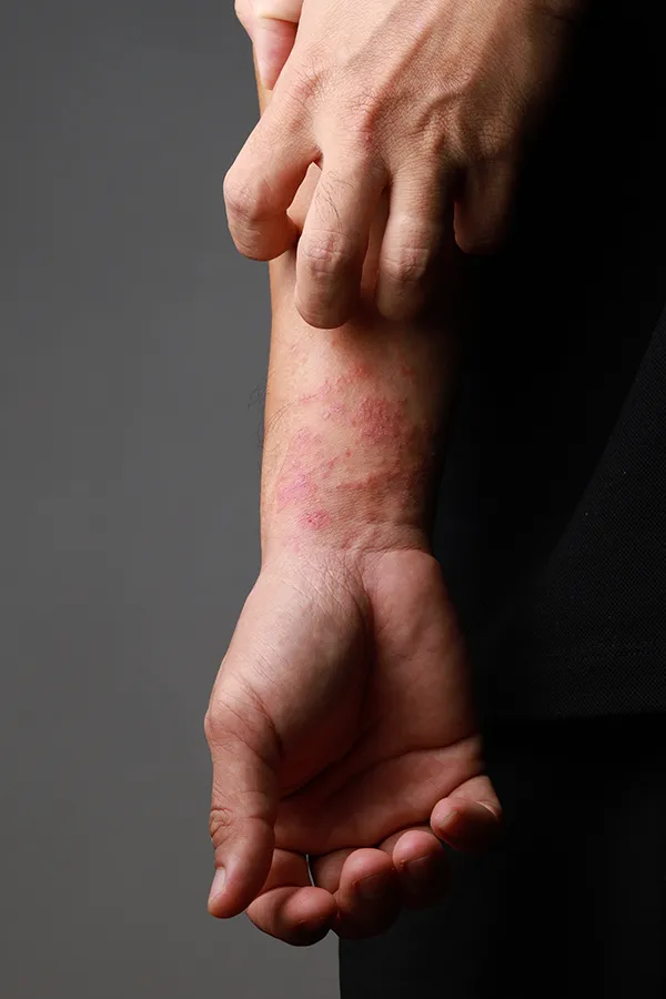 Eczema-Treatment One hand scratches an area irritated by eczema on the other wrist. Get treatment for eczema from Guerda Johnson, FNP-C in Tyler East Texas Area.