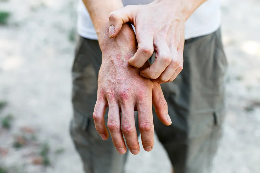 Psoriasis-Clinic Close-up of a man scratching his hands while experiencing Psoriasis. Get care for Psoriasis from Guerda Johnson, FNP-C in Tyler East Texas Area.