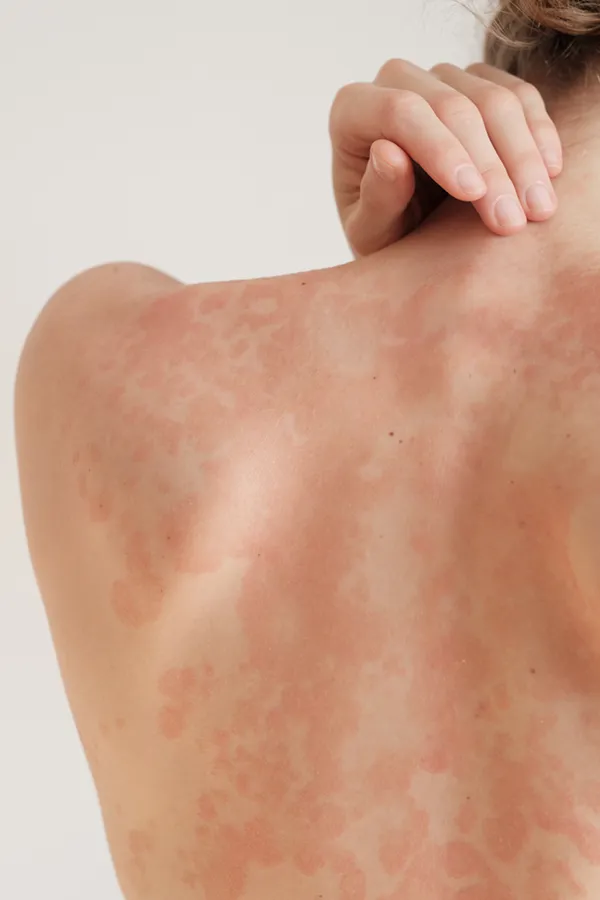 Psoriasis-Treatment The back and shoulder of a woman experiencing Psoriasis. Get treatment for Psoriasis from Guerda Johnson, FNP-C in Tyler East Texas Area.