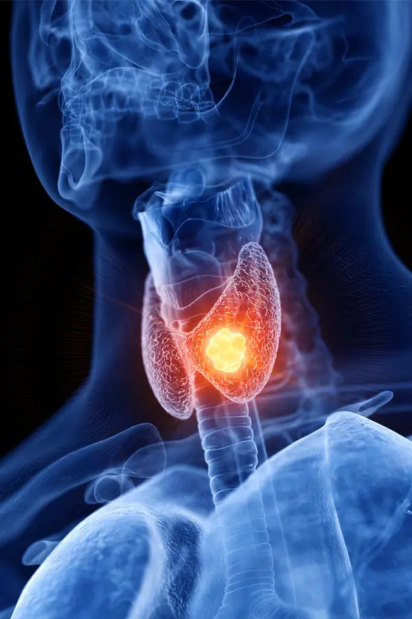 Thyroid-Imbalance-Treatment A 3D illustration of an x-ray of a human neck, highlighting the thyroid. Get help with thyroid imbalance from Guerda Johnson, FNP-C in Tyler East Texas Area.