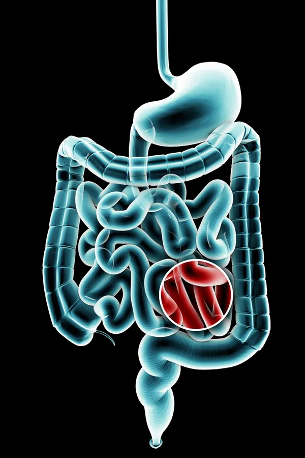 Ulcerative-Colitis-Treatment 3D illustration of the digestive system in blue tones, with an area of discomfort in red tones. Get treatment for Ulcerative Colitis from Guerda Johnson, FNP-C in Tyler East Texas Area.